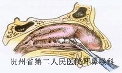 鼻息肉患者要注意哪些问题