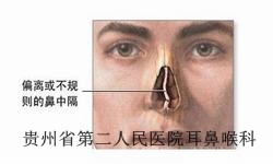 贵阳鼻中隔偏曲的危害有哪些