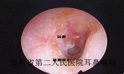 耳膜穿孔患者注意事项有哪些