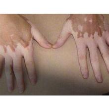 手部白癜风如何治疗