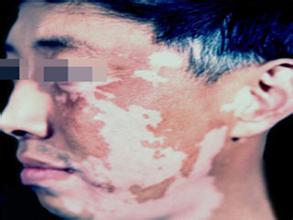 面部白癜风能治好吗