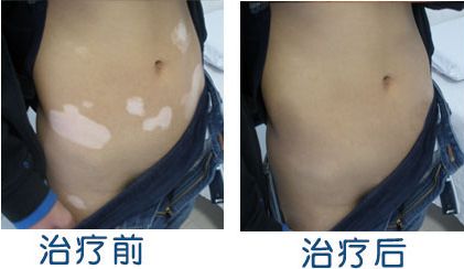 白癜风治不好?这样治事半功倍