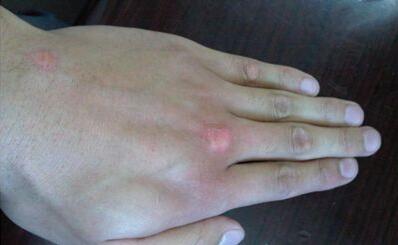 遇上白癜风,你要这么做!