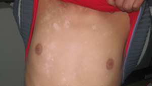 同样治疗白癜风,少了中西结合结果就是不一样