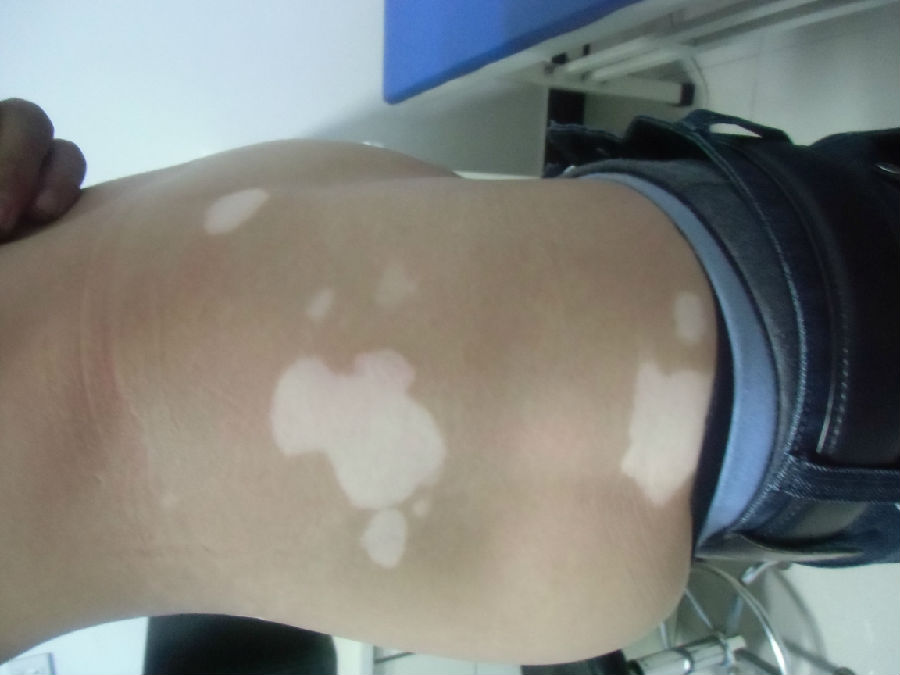 白癜风正确祛白,减少不良反应,疗效提升50%