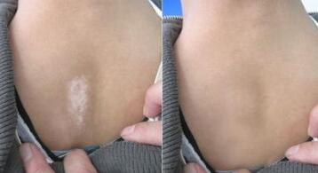 治好白癜风回家过年,你还来得及!