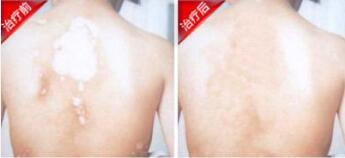 白癜风也要看准最佳治疗时机