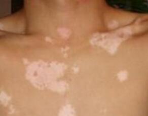 汗蒸也是一种可以用于治疗白癜风的好方法呦