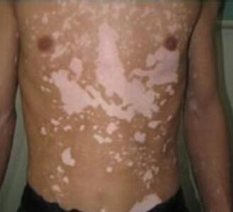 白癜风还会扩散?阻止扩散应该怎么办?