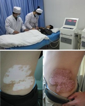 哪些方法治疗白癜风有效果好