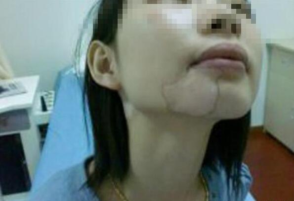 白癜风真的反复难治?你有坚持专业规范的诊疗吗?