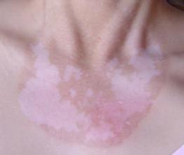 眼看白斑一点点扩展,我该怎么办才好呢