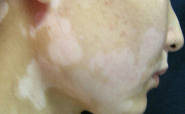 孩子脸上有白斑应该怎么去治疗