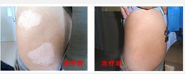 白癜风究竟能不能完全治好