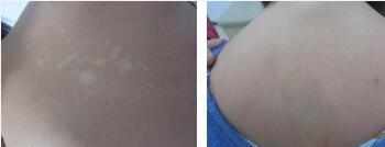 治疗白癜风需要多方面配合