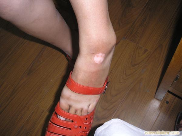 武汉治白斑帅海林专家