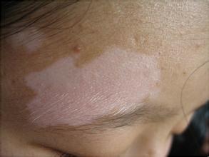 武汉治疗白颠邀请帅海林