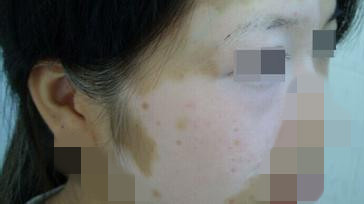 武汉脸部白癜风怎么治才恢复快