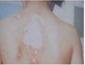 武汉治疗白癜风时患者需要了解什么