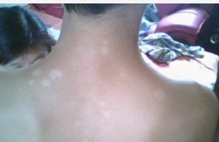 武汉白癜风怎么治疗才能好呢