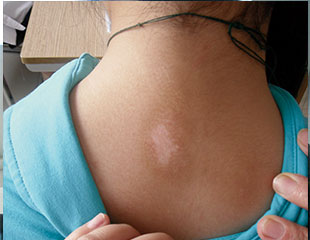 武汉儿童白癜风怎么治好