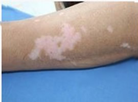 武汉白癜风根治的办法有哪些 白癜风要怎么治疗比较好呢?