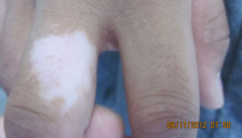 武汉早期白癜风能治吗 武汉早期白癜风能治好吗?