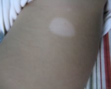 武汉治疗白癜风的新方法有哪些 武汉哪里能治愈白癜风