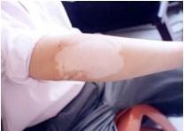 武汉小孩白癜风如何治疗 武汉手部白癜风有治吗