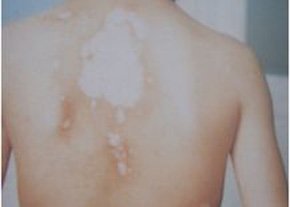 武汉怎么治白癜风效果好 武汉白癜风有治疗好的吗