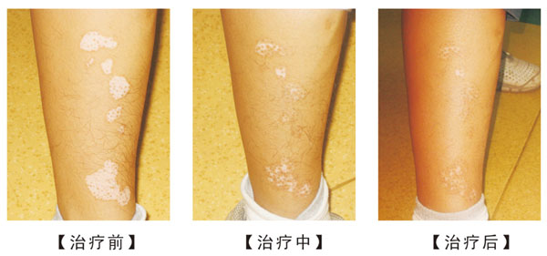 武汉正确治疗白癜风的方法 武汉早期白癜风治疗难度小