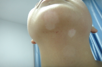 武汉最新治疗白癜风方法有什么 武汉最新治疗白癜风方法有什么