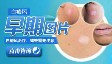 武汉白癜风初期怎么治 武汉白癜风初期怎么治
