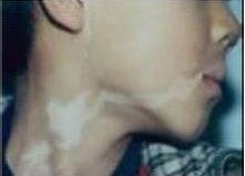 武汉白癜风能彻底治愈吗 武汉白癜风能彻底治愈吗