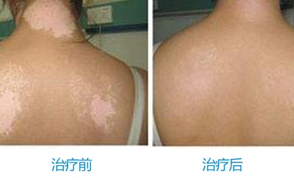 武汉治疗白癜风有效的方法 武汉白癜风的中医疗法