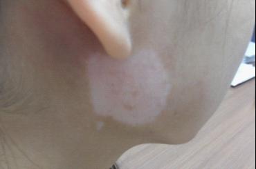 武汉白癜风初期发现好治么 武汉白癜风不能治愈吗