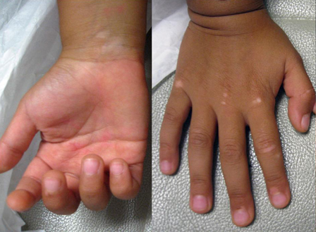 武汉白癜风初期怎么治疗方法 武汉白癜风多长时间才能治好