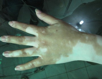 武汉早期白癜风中医治疗 武汉治疗白癜风的注意事项