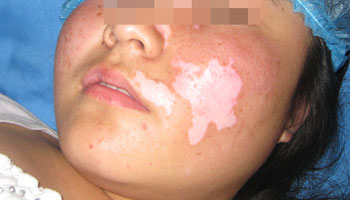 武汉白癜风病好治疗吗 武汉白癜风初期可以治愈吗?