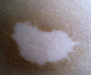 武汉存在特效药治疗白癜风吗 武汉的治疗方法有哪些呢