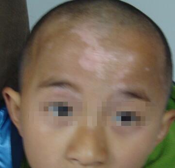 武汉白癜风的治疗需要注意什么 武汉儿童白癜风怎么治疗