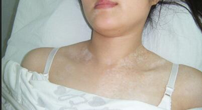 武汉治疗白癜风的原则有哪些 武汉白癜风的基本治疗方法