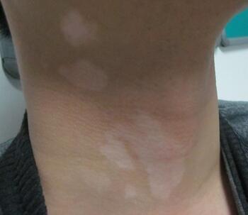 武汉如何进行白癜风的治疗 武汉白癜风早期该如何治愈