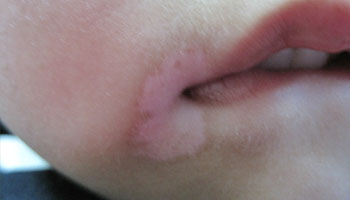 武汉白癜风早期该如何治愈 武汉如何进行白癜风的治疗