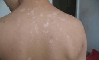 武汉早期白癜风如何治疗 武汉针对不同症状白癜风如何治疗