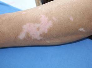 武汉儿童白癜风怎么治疗 武汉儿童白癜风怎么治疗