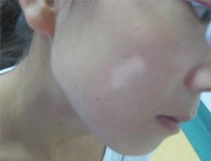 武汉白癜风的治疗原则 武汉白癜风的治疗方法有哪些呢