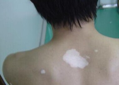 武汉得了白癜风真的就治不好了吗 武汉得了白癜风真的就治不好了吗