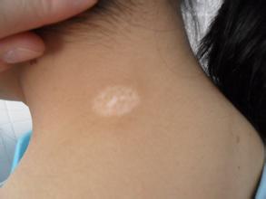 武汉学生早期白癜风如何治疗