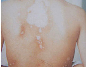 武汉青少年白癜风有哪些治疗方法